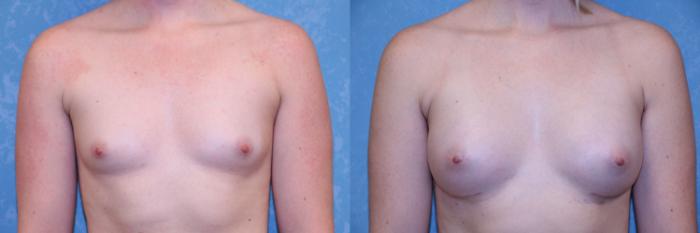 Before & After Breast Augmentation Case 510 Front View in Toledo, Ohio