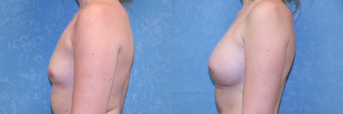 Before & After Breast Augmentation Case 510 Left Side View in Toledo, Ohio