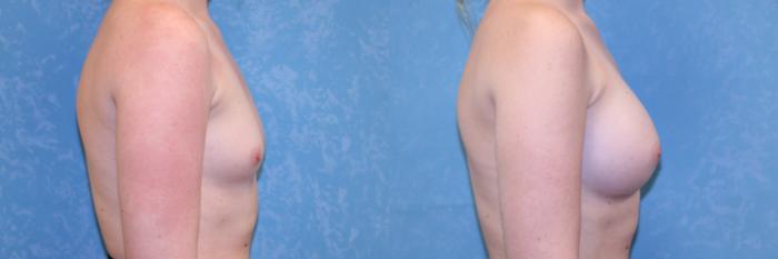 Before & After Breast Augmentation Case 510 Right Side View in Toledo, Ohio
