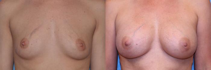 Before & After Breast Augmentation Case 511 Front View in Toledo, Ohio