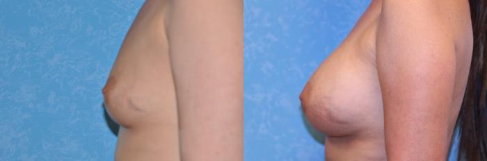 Before & After Breast Augmentation Case 511 Left Side View in Toledo, Ohio