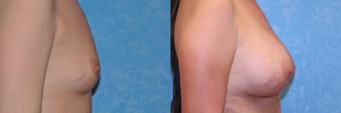 Before & After Breast Augmentation Case 511 Right Side View in Toledo, Ohio