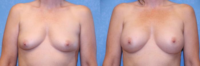 Before & After Breast Augmentation Case 525 Front View in Toledo, Ohio