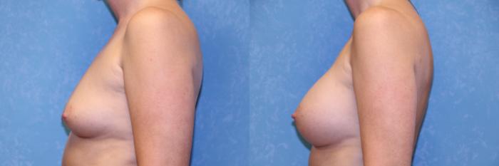 Before & After Breast Augmentation Case 525 Left Side View in Toledo, Ohio