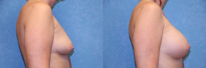Before & After Breast Augmentation Case 525 Right Side View in Toledo, Ohio
