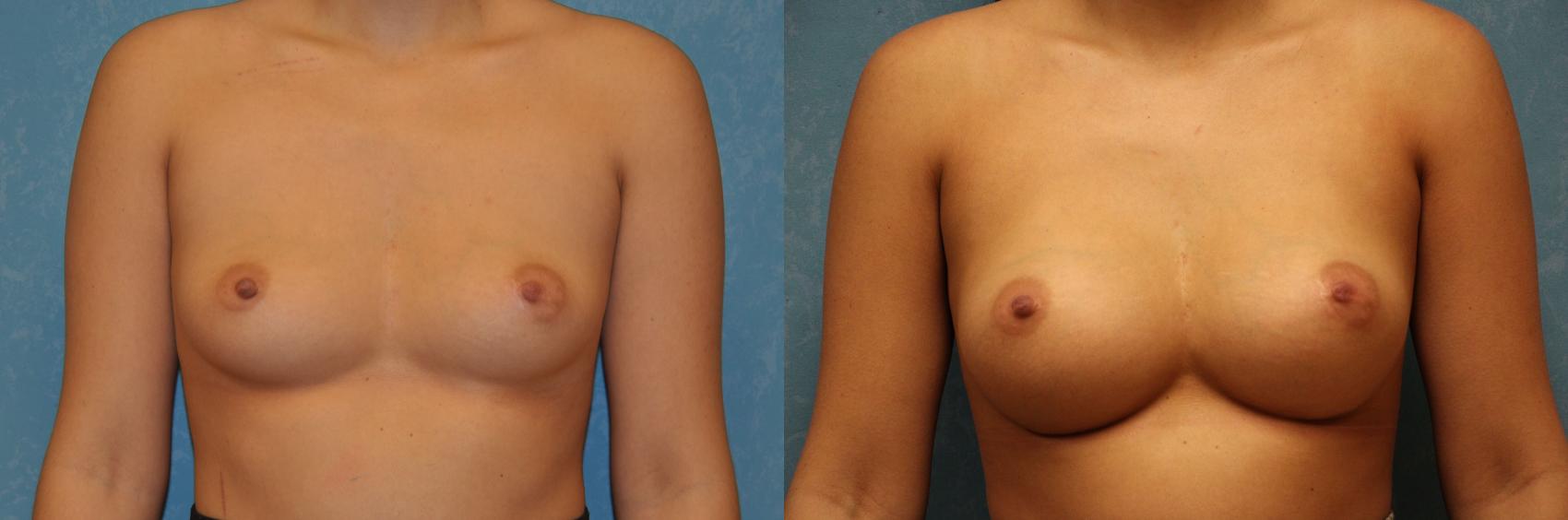 Before & After Breast Augmentation Case 526 Front View in Toledo, Ohio