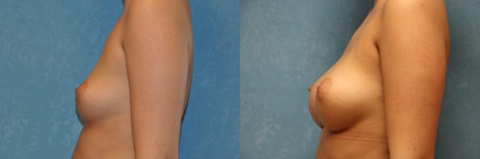 Before & After Breast Augmentation Case 526 Left Side View in Toledo, Ohio