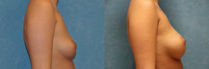 Before & After Breast Augmentation Case 526 Right Side View in Toledo, Ohio