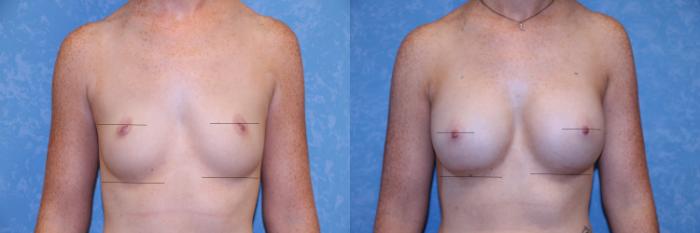 Before & After Breast Augmentation Case 527 Front View in Toledo, Ohio