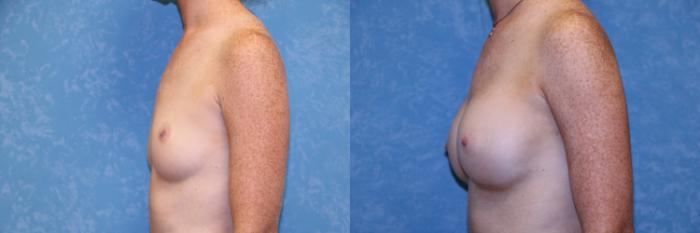 Before & After Breast Augmentation Case 527 Left Side View in Toledo, Ohio