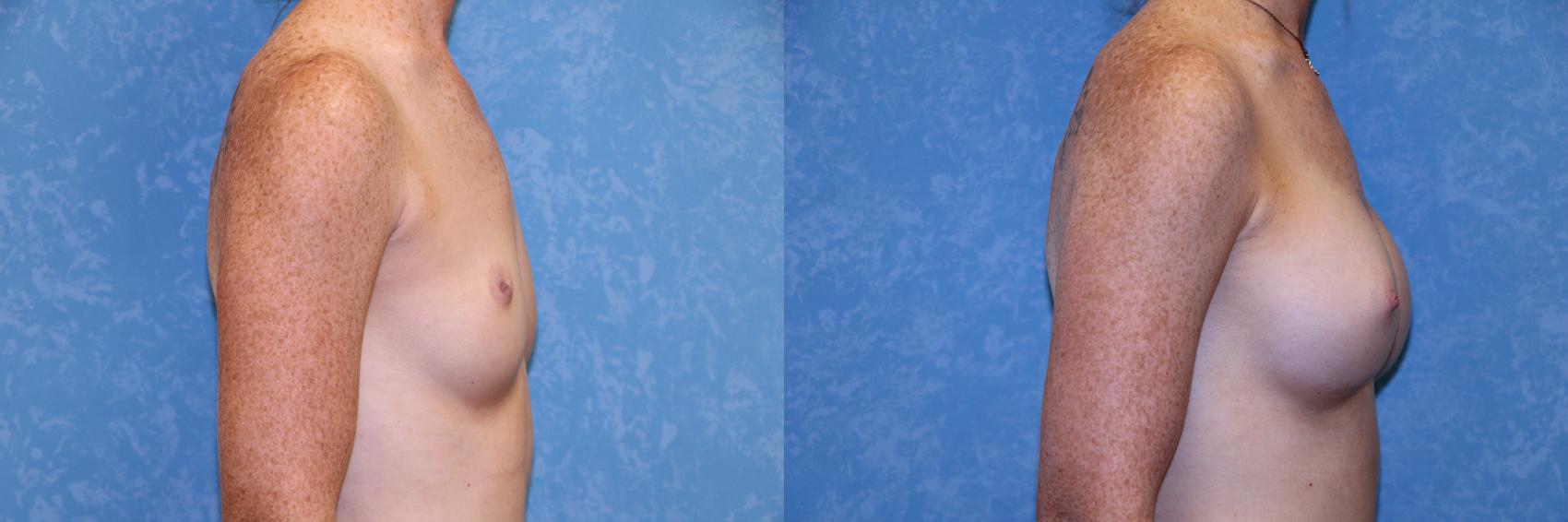 Before & After Breast Augmentation Case 527 Right Side View in Toledo, Ohio