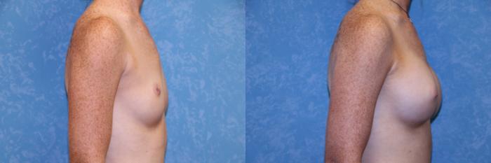 Before & After Breast Augmentation Case 527 Right Side View in Toledo, Ohio