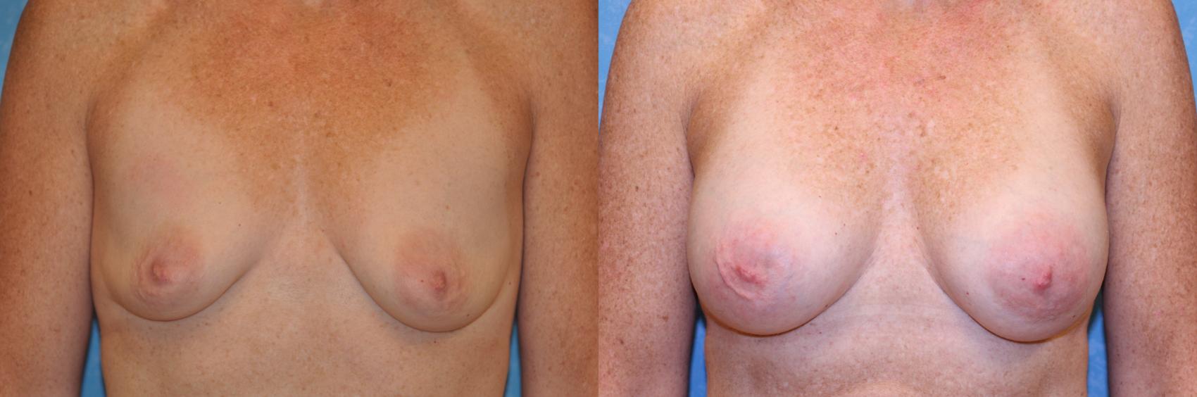 Before & After Breast Augmentation Case 530 Front View in Toledo, Ohio