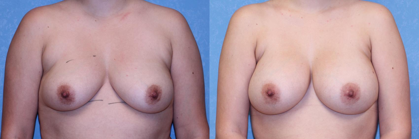 Before & After Breast Augmentation Case 531 Front View in Toledo, Ohio