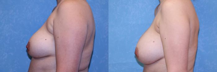 Before & After Breast Augmentation Case 531 Left Side View in Toledo, Ohio