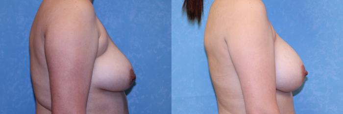 Before & After Breast Augmentation Case 531 Right Side View in Toledo, Ohio