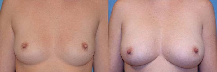 Before & After Breast Augmentation Case 534 Front View in Toledo, Ohio