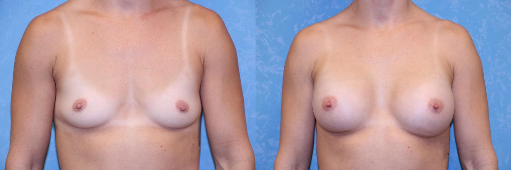 Before & After Breast Augmentation Case 539 Front View in Toledo, Ohio