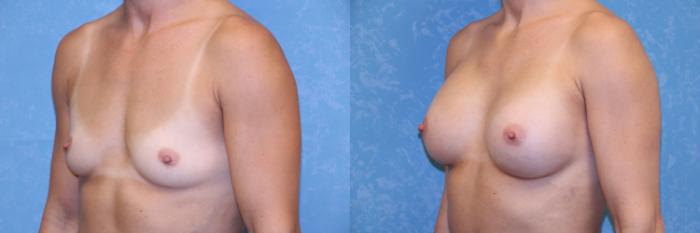 Before & After Breast Augmentation Case 539 Left Oblique View in Toledo, Ohio