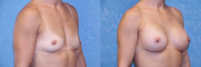 Before & After Breast Augmentation Case 539 Right Oblique View in Toledo, Ohio