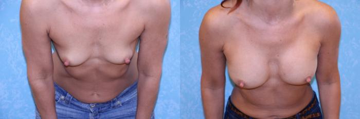 Before & After Breast Augmentation Case 542 Bent Forward View in Toledo, Ohio