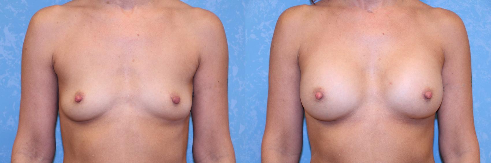 Before & After Breast Augmentation Case 542 Front View in Toledo, Ohio