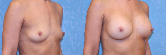 Before & After Breast Augmentation Case 542 Right Oblique View in Toledo, Ohio