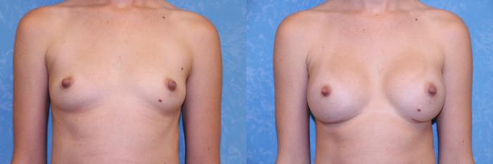 Before & After Breast Augmentation Case 547 Front View in Toledo, Ohio