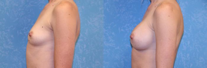 Before & After Breast Augmentation Case 547 Left Side View in Toledo, Ohio