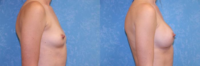 Before & After Breast Augmentation Case 547 Right Side View in Toledo, Ohio