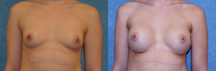 Before & After Breast Augmentation Case 548 Front View in Toledo, Ohio