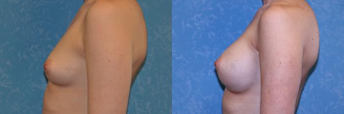 Before & After Breast Augmentation Case 548 Left Side View in Toledo, Ohio