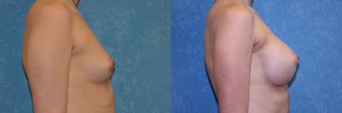 Before & After Breast Augmentation Case 548 Right Side View in Toledo, Ohio