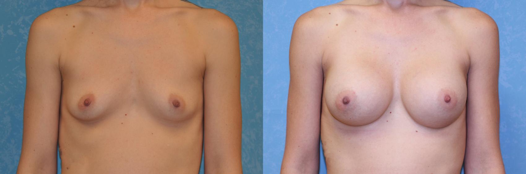 Before & After Breast Augmentation Case 549 Front View in Toledo, Ohio
