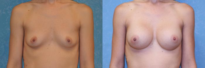 Before & After Breast Augmentation Case 549 Front View in Toledo, Ohio