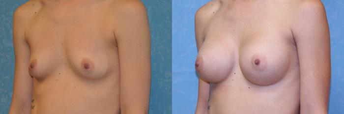 Before & After Breast Augmentation Case 549 Left Oblique View in Toledo, Ohio