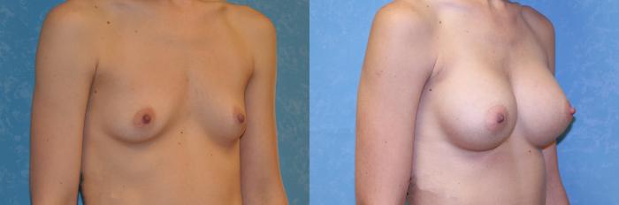 Before & After Breast Augmentation Case 549 Right Oblique View in Toledo, Ohio