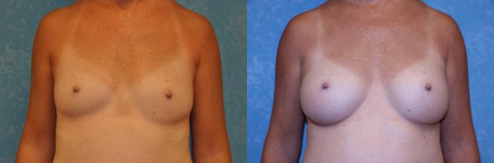 Before & After Breast Augmentation Case 560 Front View in Toledo, Ohio