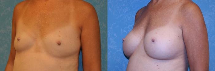 Before & After Breast Augmentation Case 560 Left Oblique View in Toledo, Ohio