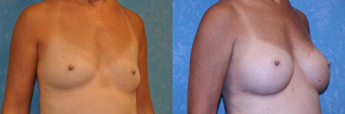 Before & After Breast Augmentation Case 560 Right Oblique View in Toledo, Ohio