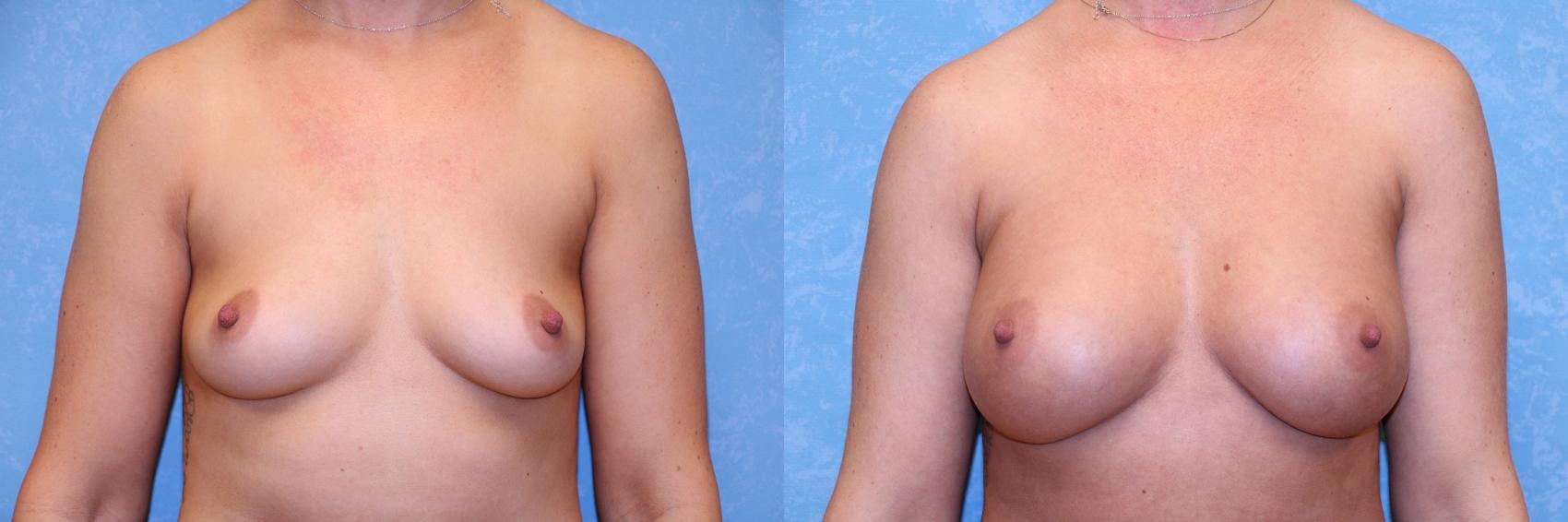Before & After Breast Augmentation Case 563 Front View in Toledo, Ohio