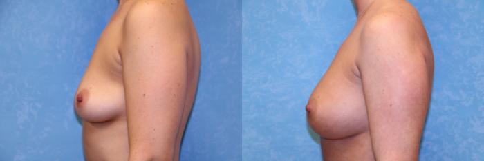 Before & After Breast Augmentation Case 563 Left Side View in Toledo, Ohio