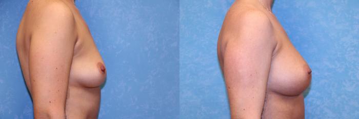 Before & After Breast Augmentation Case 563 Right Side View in Toledo, Ohio