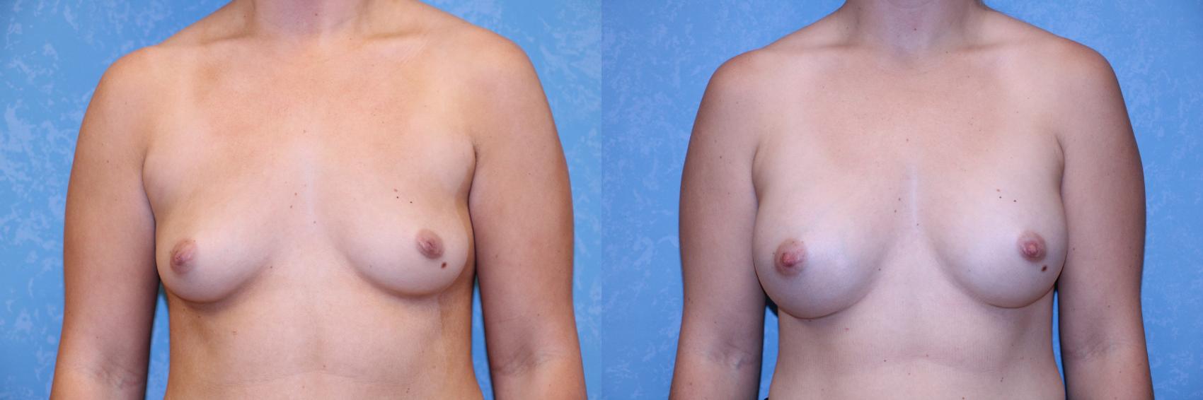 Before & After Breast Augmentation Case 565 Front View in Toledo, Ohio