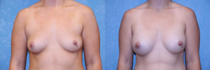 Before & After Breast Augmentation Case 565 Front View in Toledo, Ohio
