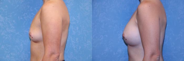 Before & After Breast Augmentation Case 565 Left Side View in Toledo, Ohio