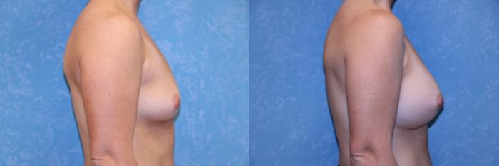 Before & After Breast Augmentation Case 565 Right Side View in Toledo, Ohio