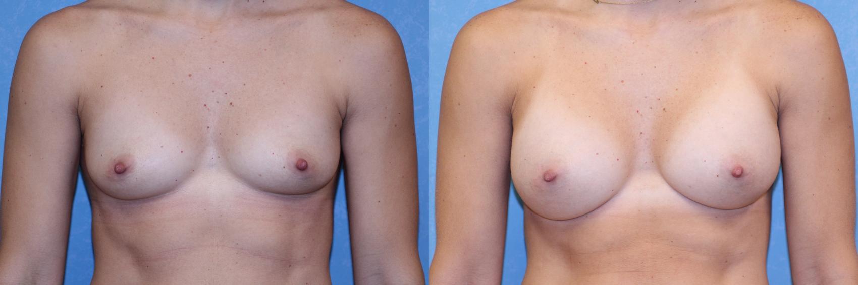 Before & After Breast Augmentation Case 567 Front View in Toledo, Ohio