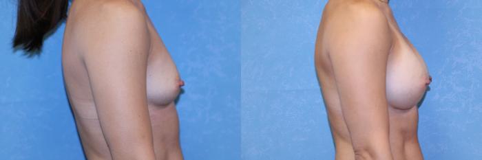 Before & After Breast Augmentation Case 567 Right Side View in Toledo, Ohio