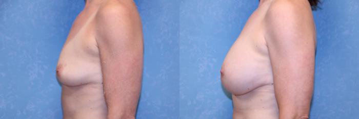 Before & After Breast Augmentation Case 568 Left Side View in Toledo, Ohio